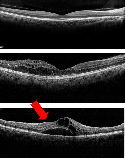 It’s All About ME – What to Know About Macular Edema - Discovery Eye ...