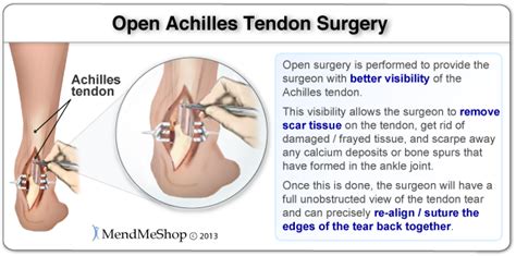 Post Surgery Rehabilitation - Achilles Tendonitis