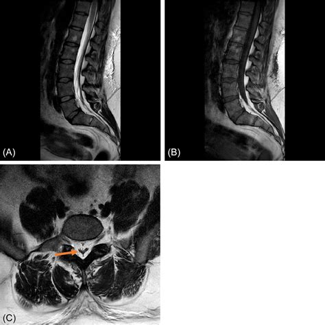 Lumbosacral Spine MRI | Radiology Key