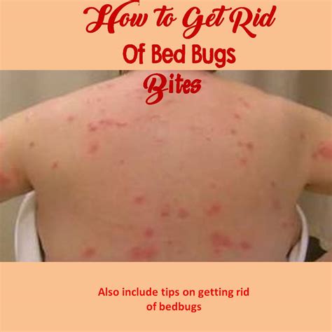 How to Get Rid Of Bed Bug Bites - Online Pest Control