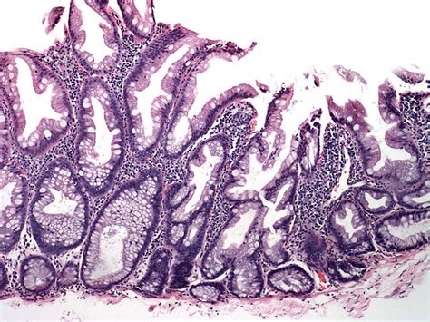 Pathology Outlines - Sessile serrated adenoma