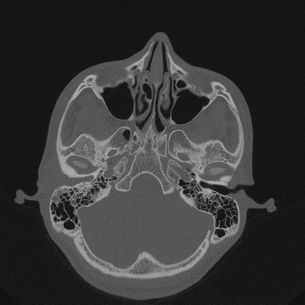 Keratosis obturans | Radiology Case | Radiopaedia.org