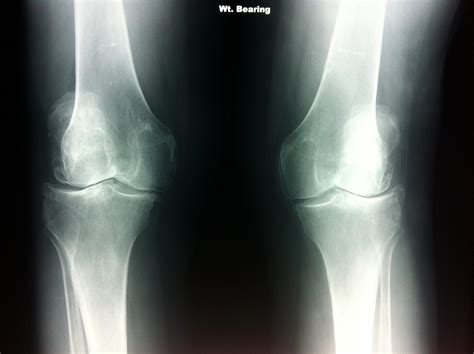 Bilateral knee osteoarthritis x-ray AP – Podiatrist Brisbane Southside ...