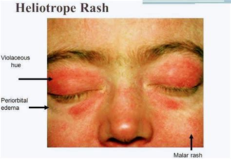 Symptoms of Dermatomyositis - PT Master Guide