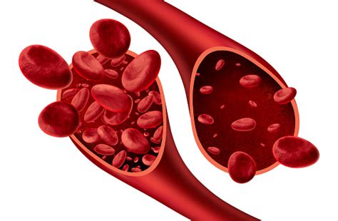 chronic ischemic microvascular disease - Newstrendline.Com