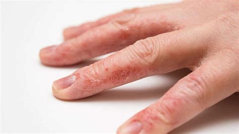 Delgocitinib Successful for Hand Eczema in Phase 2b Trial