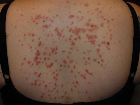 What Is Guttate Psoriasis and How Can You Treat It?