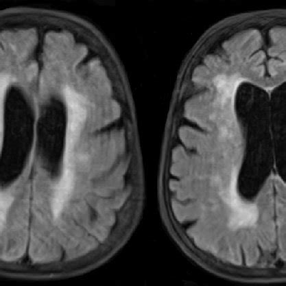 MRI of the brain showing severe diffuse atrophy for her age with ...