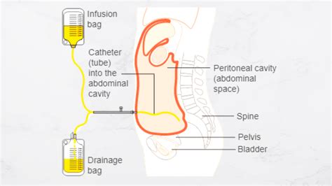 The Indications for Urinary Catheterization and the Various ...