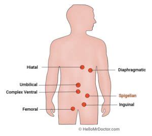 Spigelian Hernia - Pictures, Location, Causes, Treatment