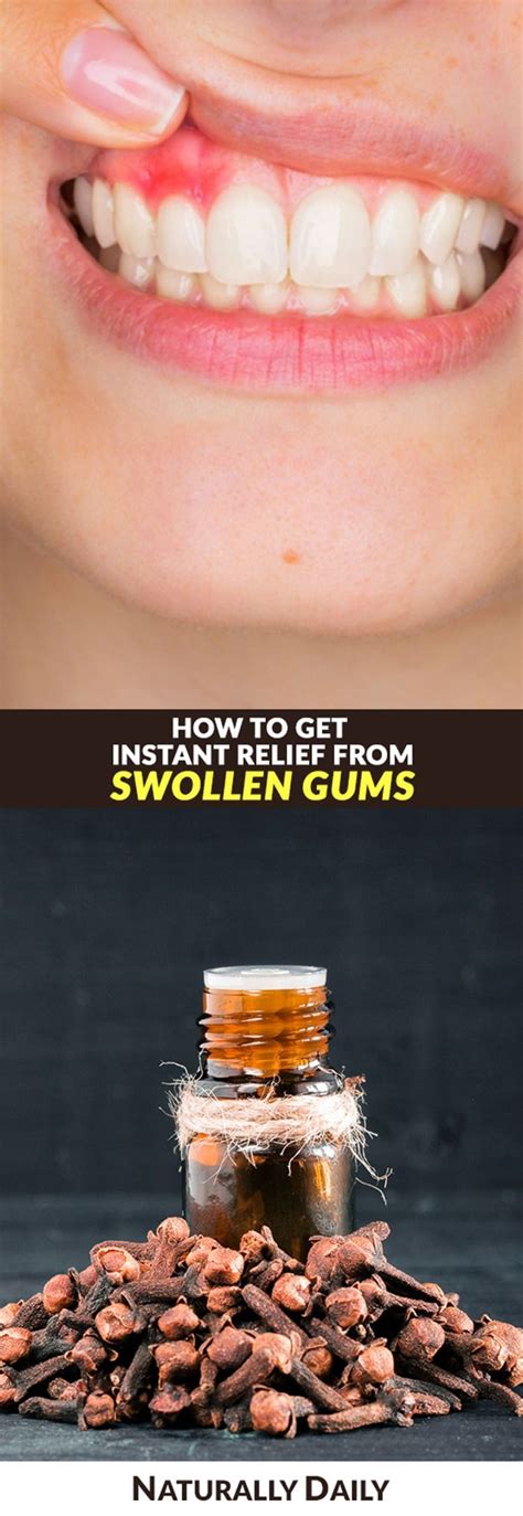 Home Remedies for Swollen Gums for Instant Relief # ...