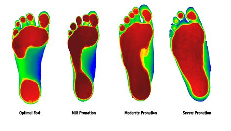 Foot Levelers Advantage – Middletown Health & Wellness Center