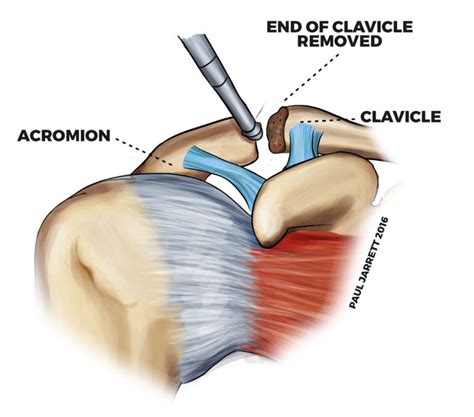 Mr Paul Jarrett | Acromioclavicular Joint Arthritis or Arthropathy ...