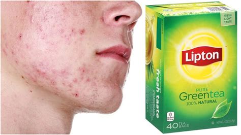 How to Use Green Tea for Acne - YouTube