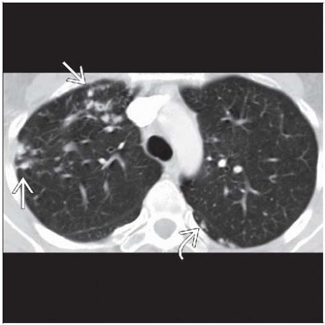 Mycobacterium Avium Complex | Radiology Key