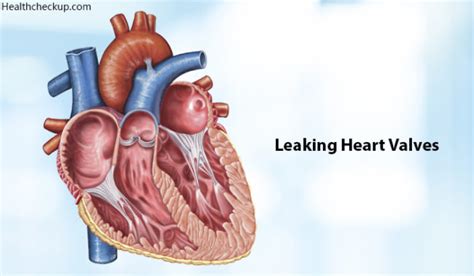 Leaking Heart Valves Life Expectancy, Causes, Signs, Treatment by Dr ...