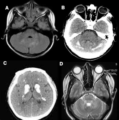 Imaging of Dentate Nucleus Pathologies: A Case Series - Journal of ...