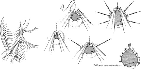 Choledochoenteric Anastomosis by Choledochoduodenostomy and Other ...