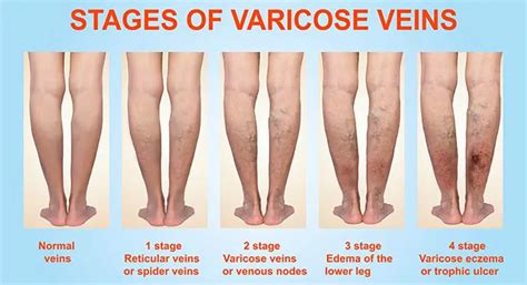 Varicose Veins Explained, Causes and Treatments | SearchGo