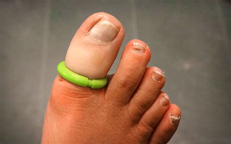 Ingrown Toenail Surgery | Sole Podiatry