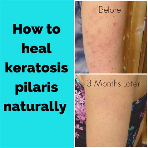 Treatment for Keratosis Pilaris | Dry skin bumps, Keratosis pilaris ...