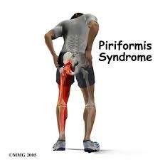 Piriformis Syndrome Massage