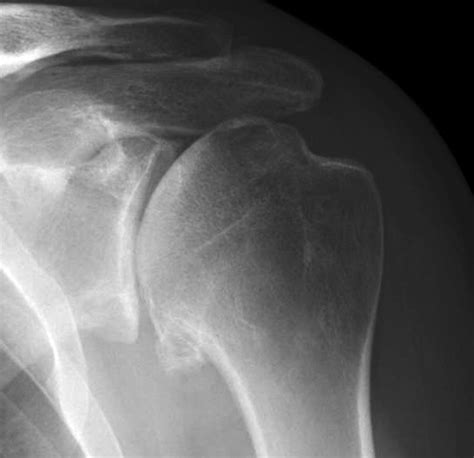 Shoulder Arthritis / Rotator Cuff Tears: causes of shoulder pain ...