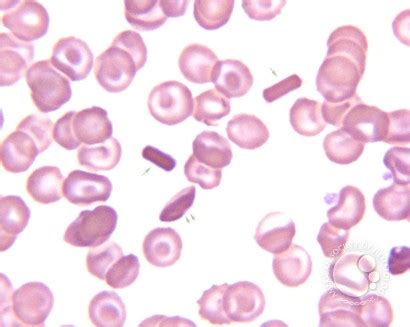 Hemoglobin C crystals - 1.