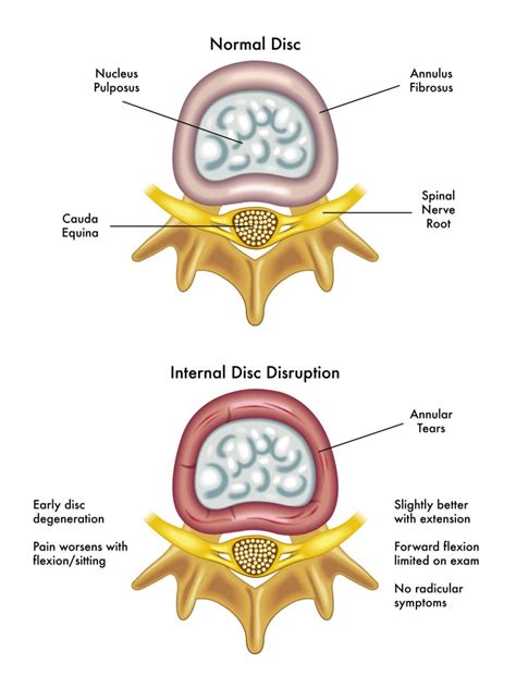 Cauda Equina Syndrome – A Rare Spinal Condition