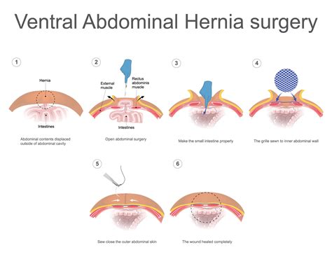 Ventral Umbilical Hernia