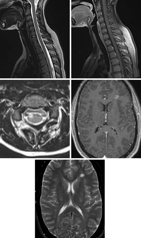 Cervical Spine Mri Ms