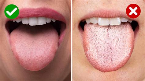 5 Things a White Tongue May Reveal About Your Health | Power of Positivity