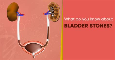 Bladder stones - Symptoms, causes, diagnosis, treatment - Star Health