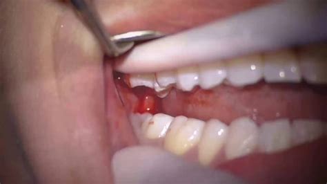 Maxillary Third Molar Extraction - YouTube