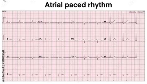 Electrocardiogram show atrial paced rhythm. Cardiac Pacemaker. Heart ...