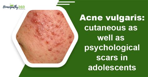 Acne vulgaris: cutaneous as well as psychological scars in adolescents ...