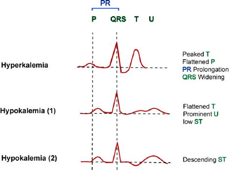 Ecg Changes In Hyperkalemia And Hypokalemia Causes Diagnosis | The Best ...