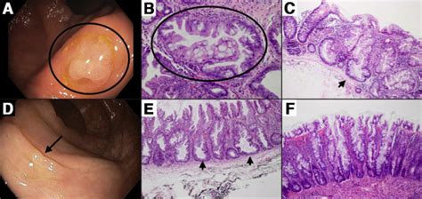 Sessile Serrated Polyp