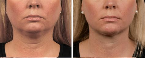 CoolSculpting for a Double Chin | London Premier Laser Clinic