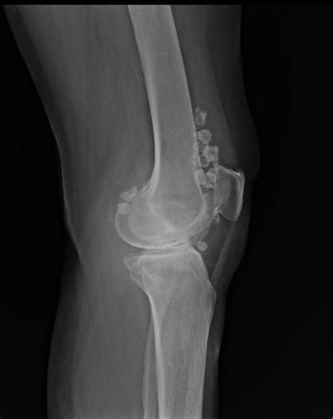 Synovial chondromatosis | Radiology Reference Article | Radiopaedia.org ...