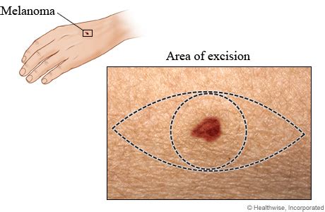 Melanoma Excision and Scar | University of Michigan Health System