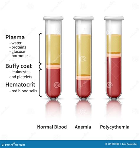 Hematocrit Test Concept. Royalty-Free Stock Photography | CartoonDealer ...