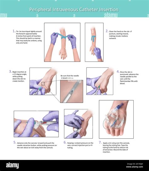 Site Of Intravenous Catheter Insertion And Blood Draws