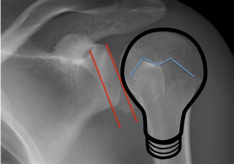 Doc Cottle's Desk: Posterior shoulder dislocation confirmed by ultrasound