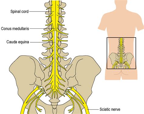 Cauda Equina Syndrome: Symptoms, Causes, Treatment By Back Braces