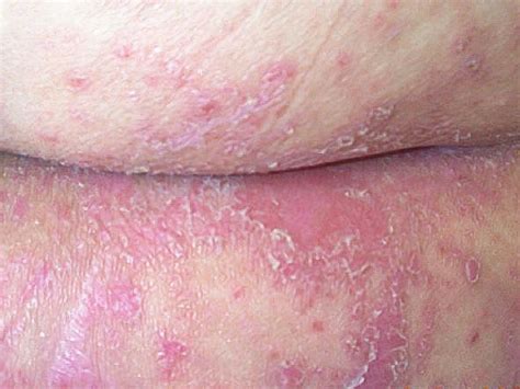 Yeast Infection on Your Skin (Cutaneous Candidiasis)