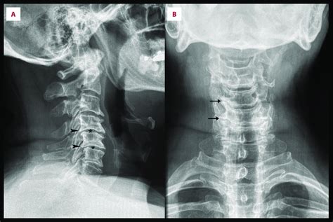 Normal Cervical Spine Radiographs Image Radiopaediaorg