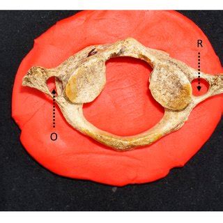 Shape of the foramen transversarium. (O: oval-shaped and R: round ...