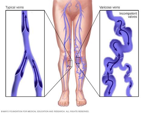 Varicose veins - Symptoms and causes - Mayo Clinic