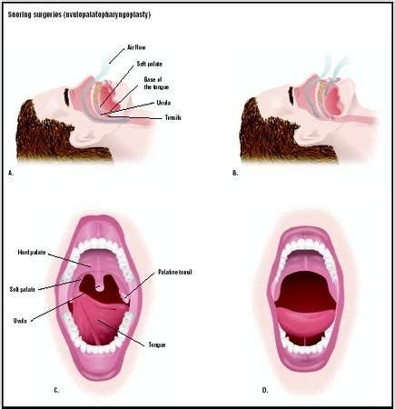 Snoring Surgery - procedure, recovery, test, blood, removal, pain ...